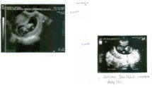 Sonogram of two babies.