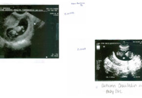 Sonogram of two babies.